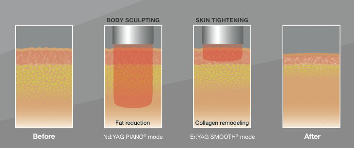 bodysculpting